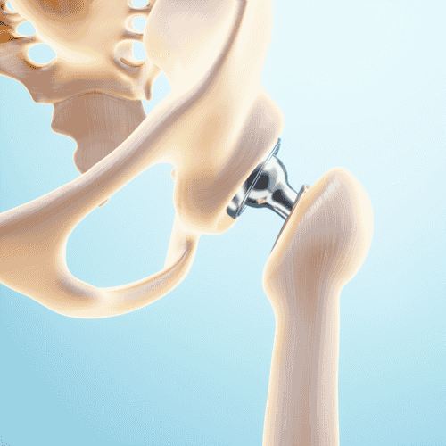 Hip Replacement Package by Group Florence in Istanbul, Turkey