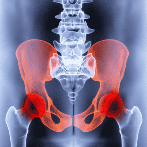 Hip Replacement in Mexico - Explore the Package
