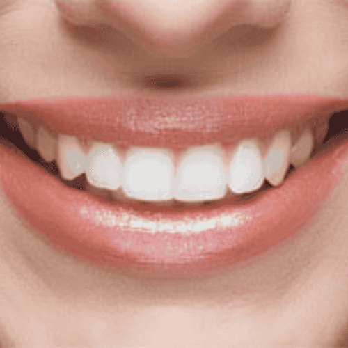 All on 4 Dental Implants Package in Cancun, Mexico