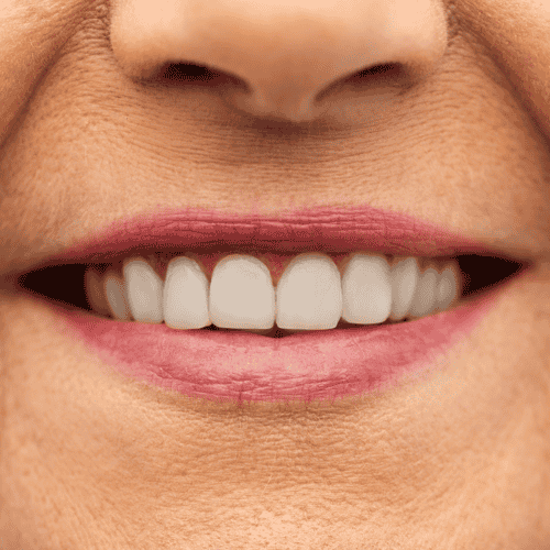 Get Affordable Teeth Whitening Package in Antalya, Turkey 