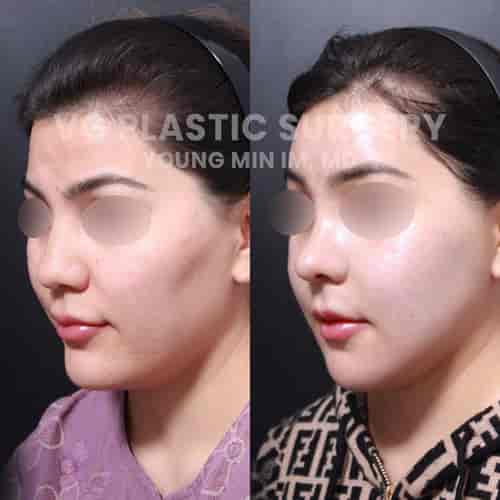 Facial Contouring Package in Seoul, South Korea by VG Plastic Surgery