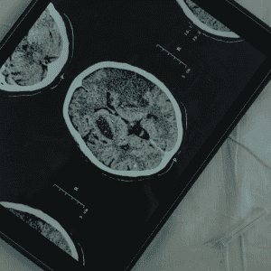 Stem Cell Therapy for Brain Injury Mexico | Tijuana | Cost