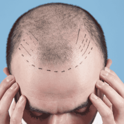 Best FUE Hair Transplant in Istanbul, Turkey – $1,300 at Clinic Prime