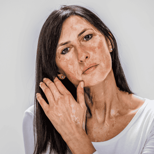 Treatment for Vitiligo