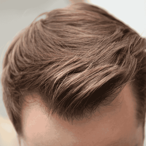 FUE Hair Transplant in Bellus Clinic - get your hair back with Bellus Clinic