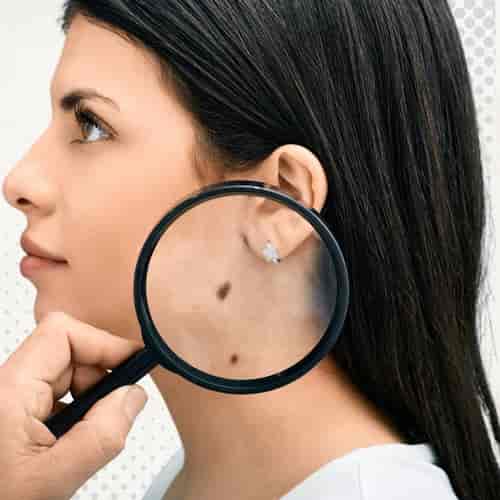 TILs Therapy Package for Skin Cancer in China by Beijing Bioocus Medical Group