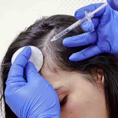 Non-Surgical Stem Cell Hair Restoration Mexico Package at CellsTime Guadalajara