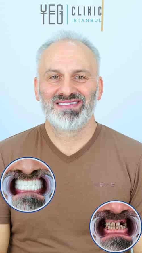 All on 6 Dental Implants Package at YEG Clinic - Best Dental Clinic Istanbul, İstanbul, Turkey