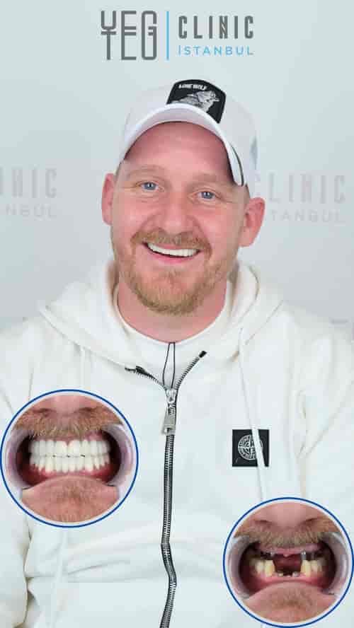 All on 4 Dental Implants Package at YEG Clinic - Best Dental Clinic Istanbul, İstanbul, Turkey