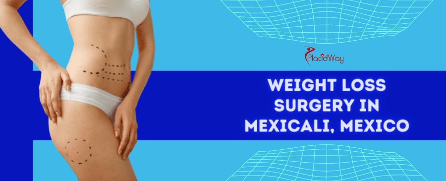 Weight Loss Surgery in Mexicali, Mexico thumbnail