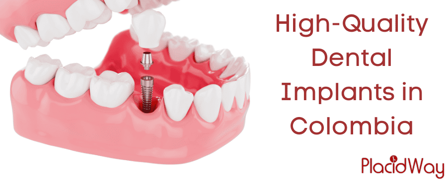 High-Quality Dental Implants in Colombia thumbnail