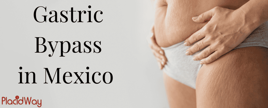 Gastric Bypass in Mexico - Lose Weight Today! thumbnail