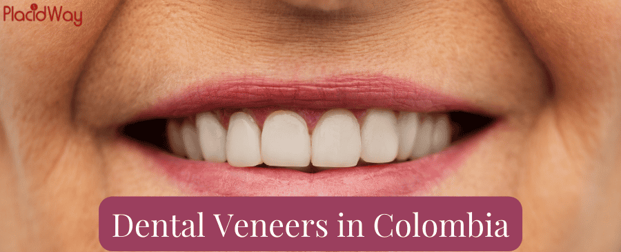 Get Cheap and Safe Dental Veneers in Colombia thumbnail
