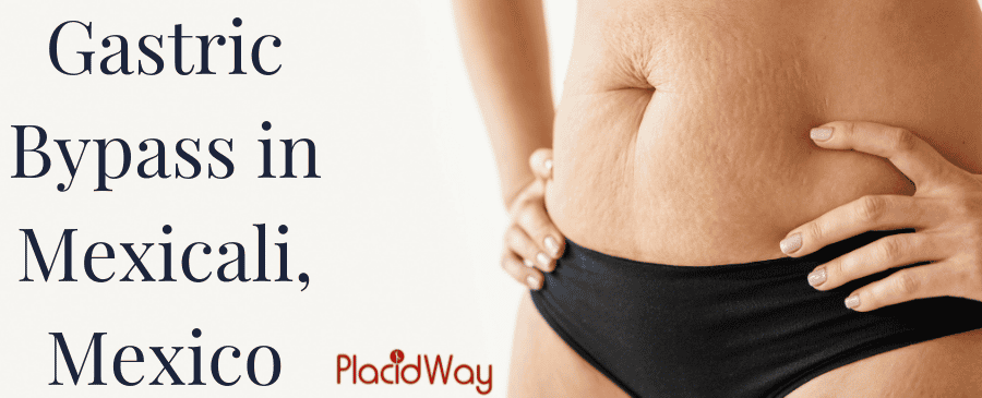 Gastric Bypass in Mexicali, Mexico thumbnail