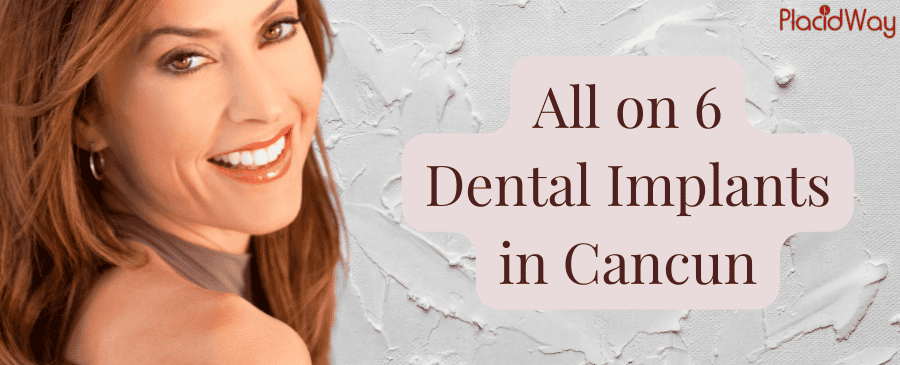 All on 6 Dental Implants in Cancun, Mexico thumbnail