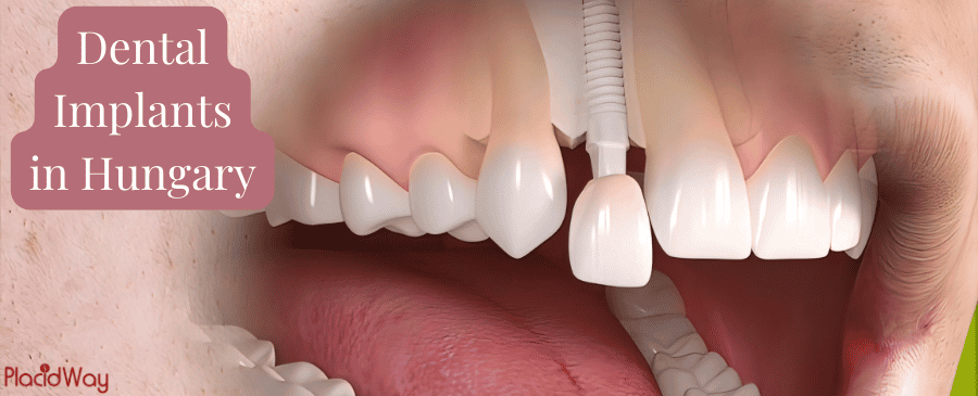 Dental Implants in Hungary for Your Confident Smile thumbnail