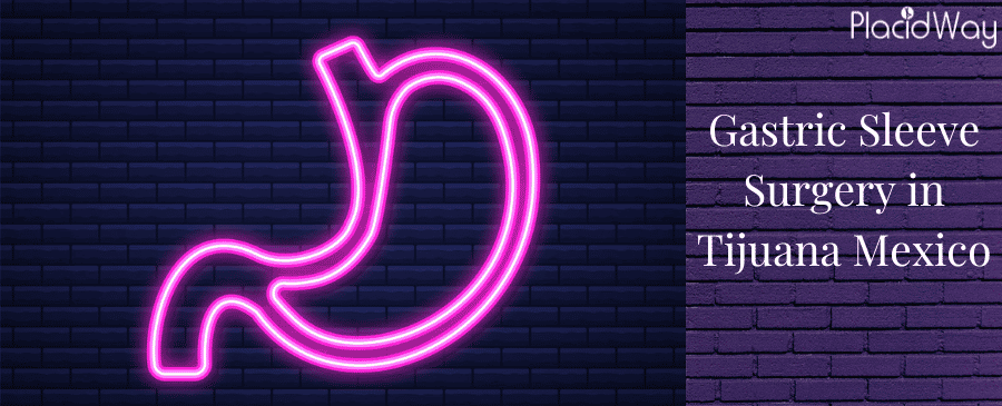 Gastric Sleeve Surgery in Tijuana, Mexico thumbnail