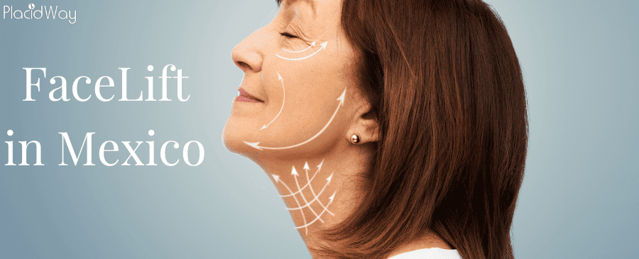Facelift in Mexico - Restore Your Youthful Look thumbnail