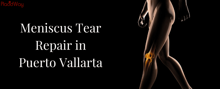 Meniscus Tear Repair in Puerto Vallarta, Mexico thumbnail