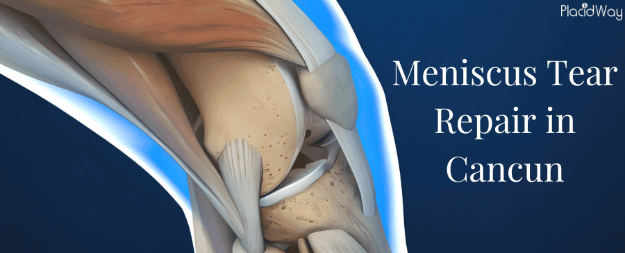 Meniscus Surgery in Cancun Mexico thumbnail