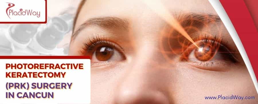 PRK Surgery in Cancun thumbnail