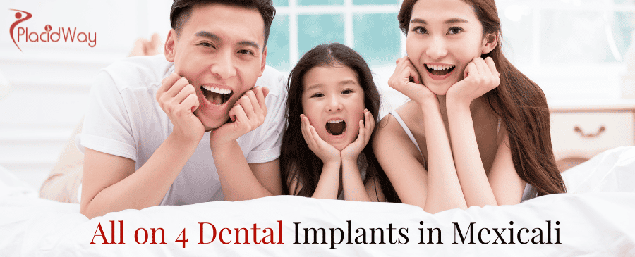 All on 4 Dental Implants in Mexicali thumbnail
