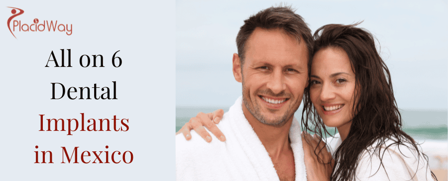 All on 6 Dental Implants in Mexico thumbnail