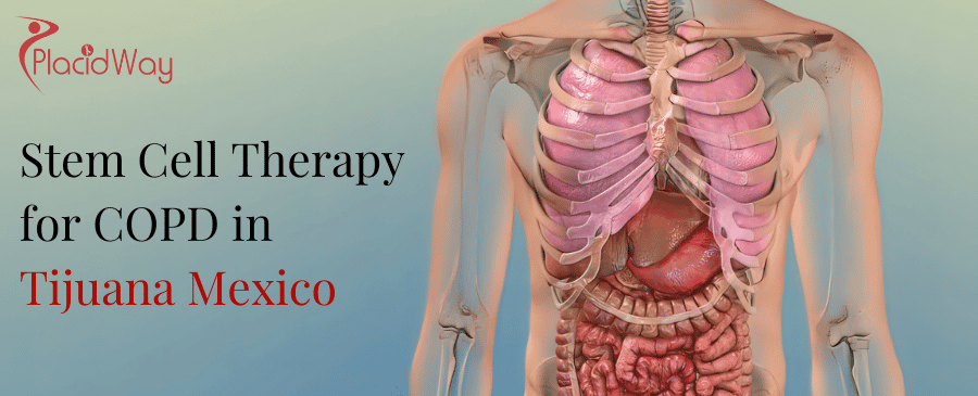 Stem Cell Therapy for COPD in Tijuana Mexico thumbnail