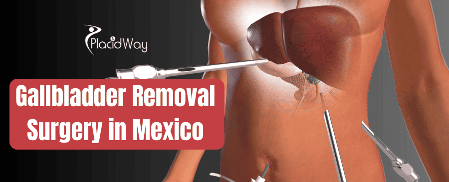 Gallbladder Removal Surgery in Mexico thumbnail