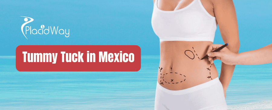 Tummy Tuck in Mexico thumbnail