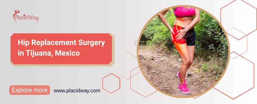 Hip Replacement Surgery in Tijuana, Mexico thumbnail