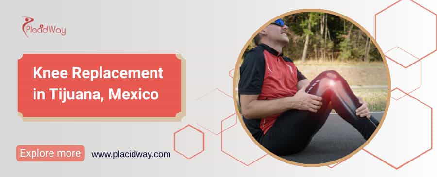 Knee Replacement in Tijuana, Mexico thumbnail