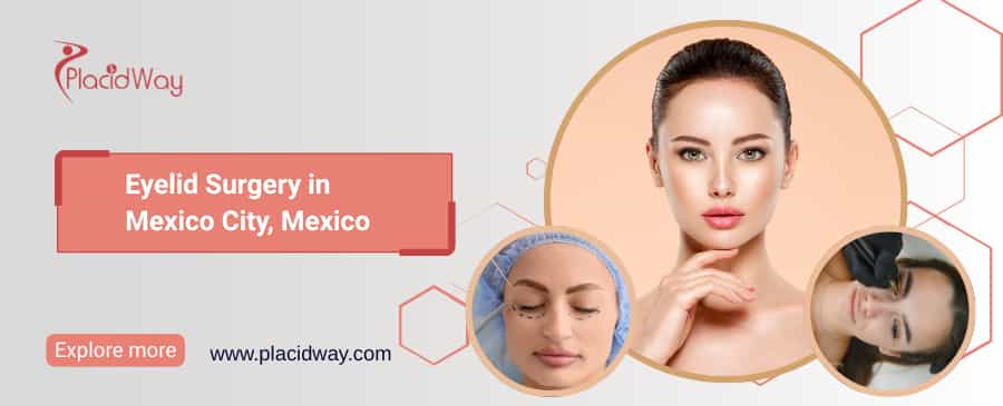 Eyelid Surgery in Mexico City, Mexico thumbnail