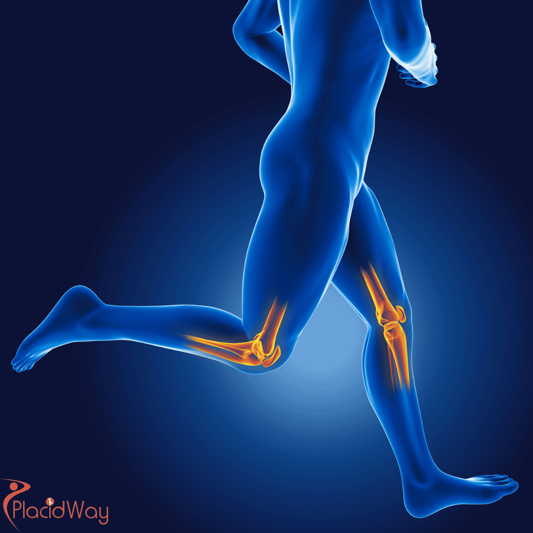 Slovakia's Innovative Approach: Enhancing Orthopedic Healing with Exosome-Enriched Stem Cell Therapies