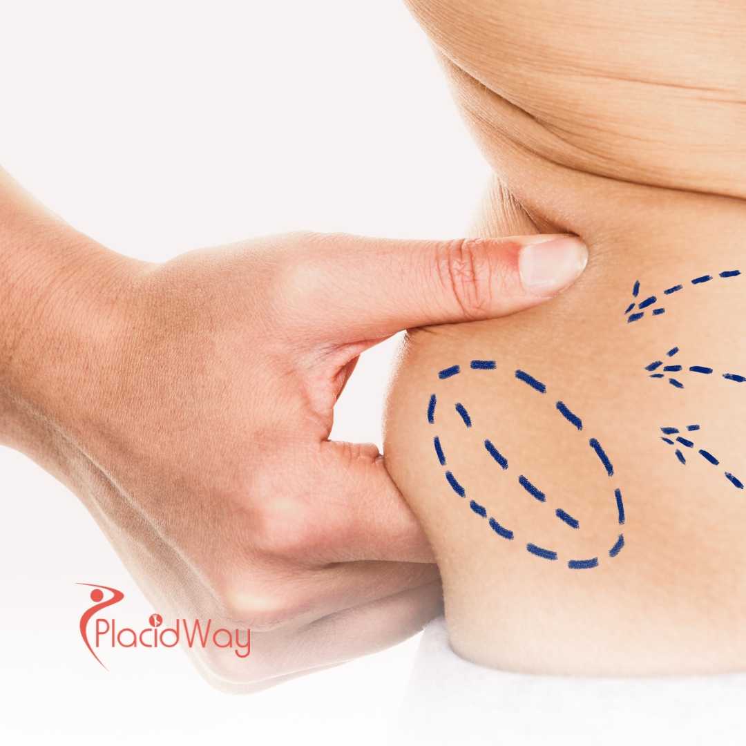 Why Mexicali, Mexico is the Top Choice for Affordable Liposuction for Arizona Residents