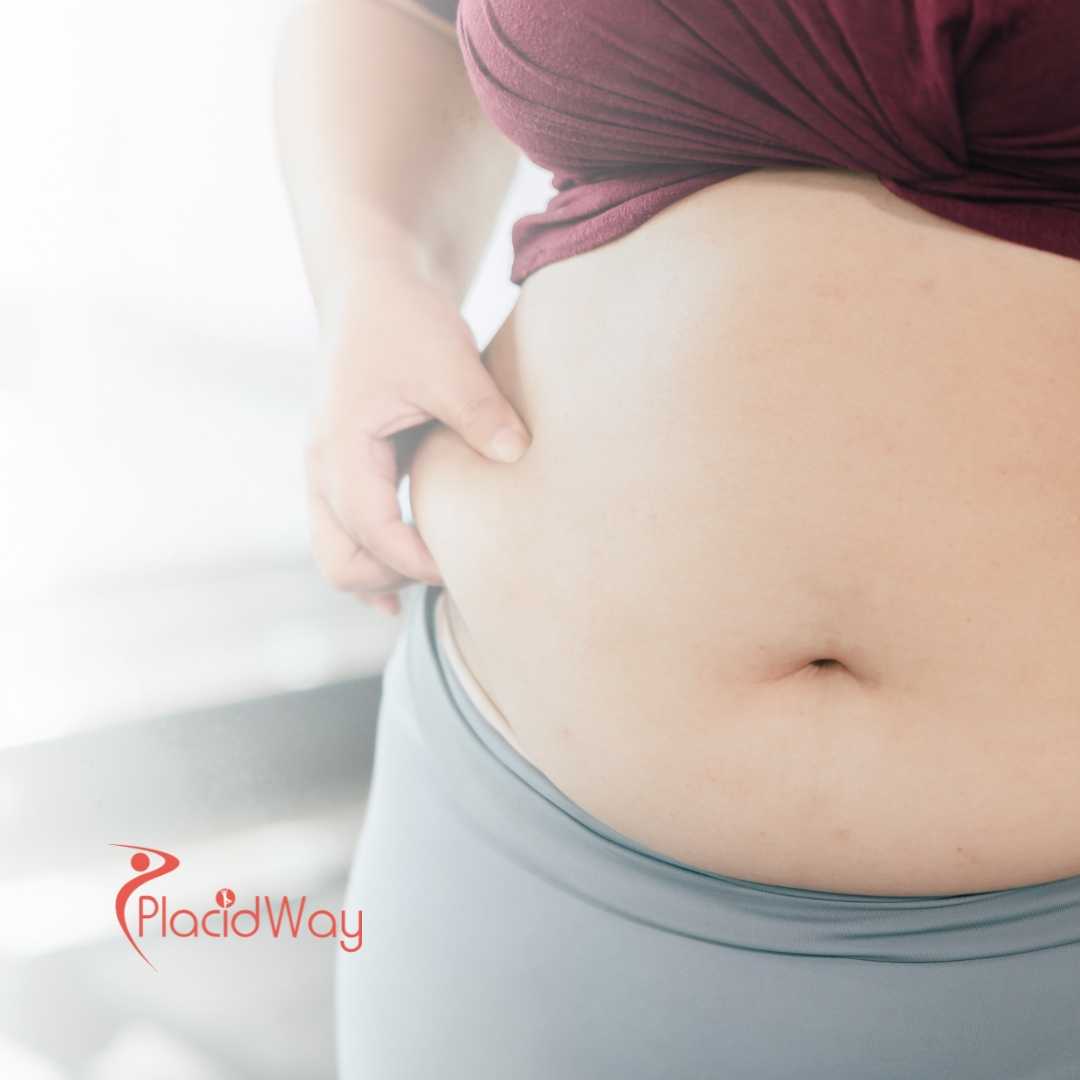 Gastric Bypass for Vancouver Patients in Mexicali, Mexico