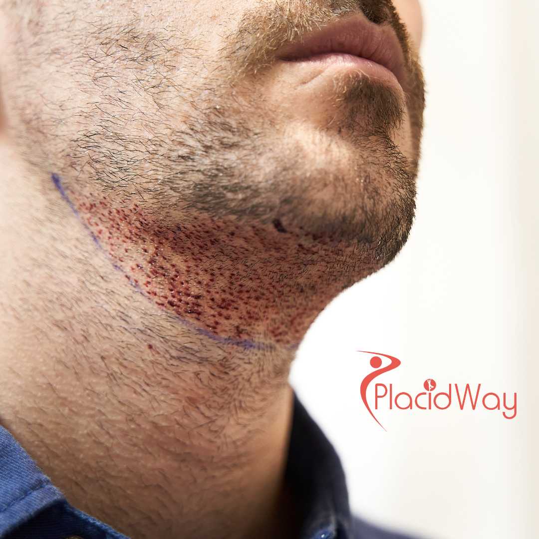 Beard Hair Transplant in Turkey for US Patients