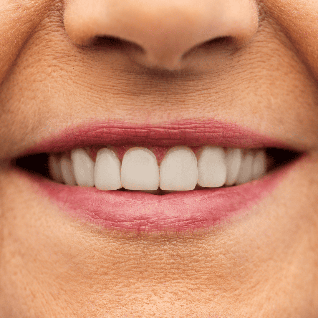 Get Cheap and Safe Dental Veneers in Colombia