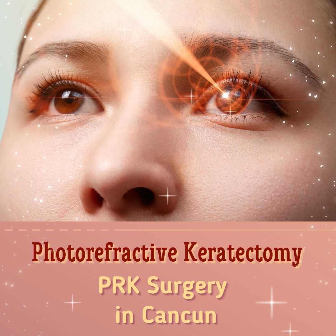 PRK Surgery in Cancun