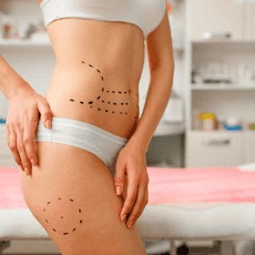 Mommy Makeover Package in Merida, Mexico by Dr. Ernesto Acosta Abeyta