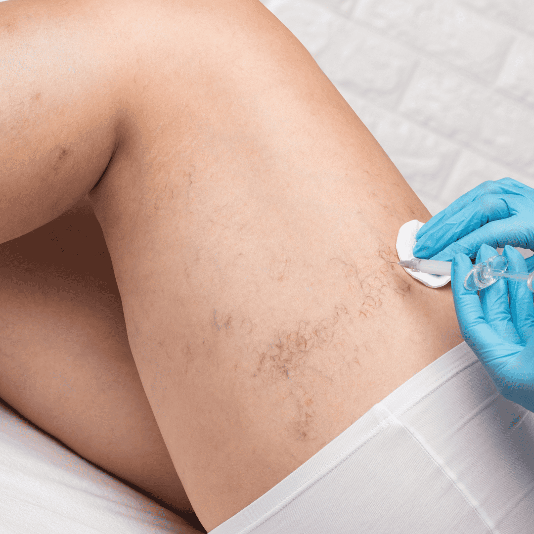 Permanent Spider Vein Removal in Costa Rica: Affordable, Effective, and Expert Care