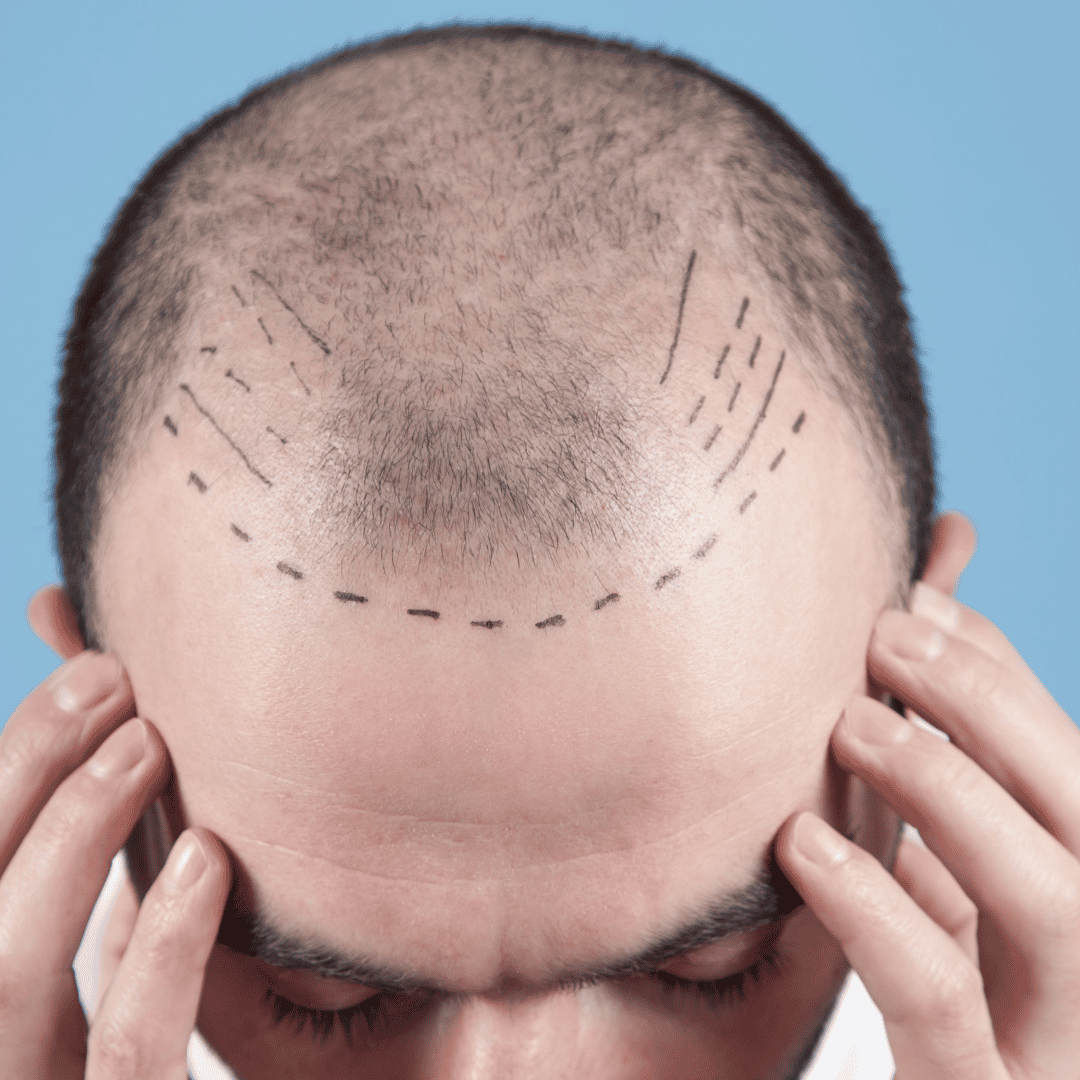 Best FUE Hair Transplant in Istanbul, Turkey – $1,300 at Clinic Prime