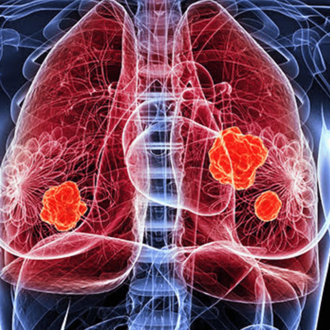 Affordable Lung Cancer Treatment in Havana, Cuba – Starting at $5,184