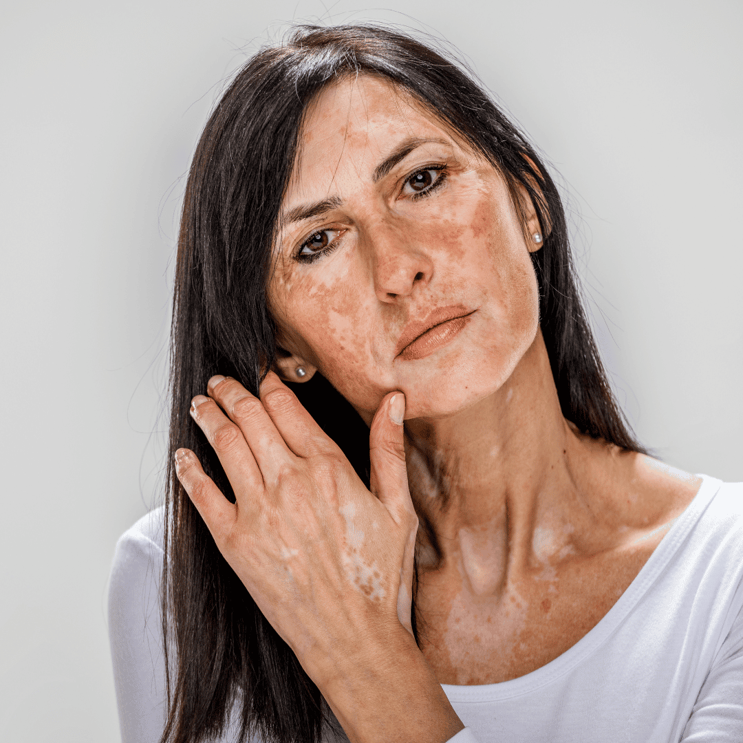 Treatment for Vitiligo
