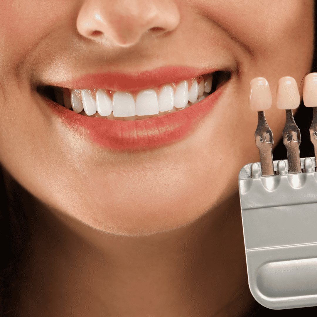 Smile makeover in Istanbul - Hollywood smile, implants, crowns in Istanbul