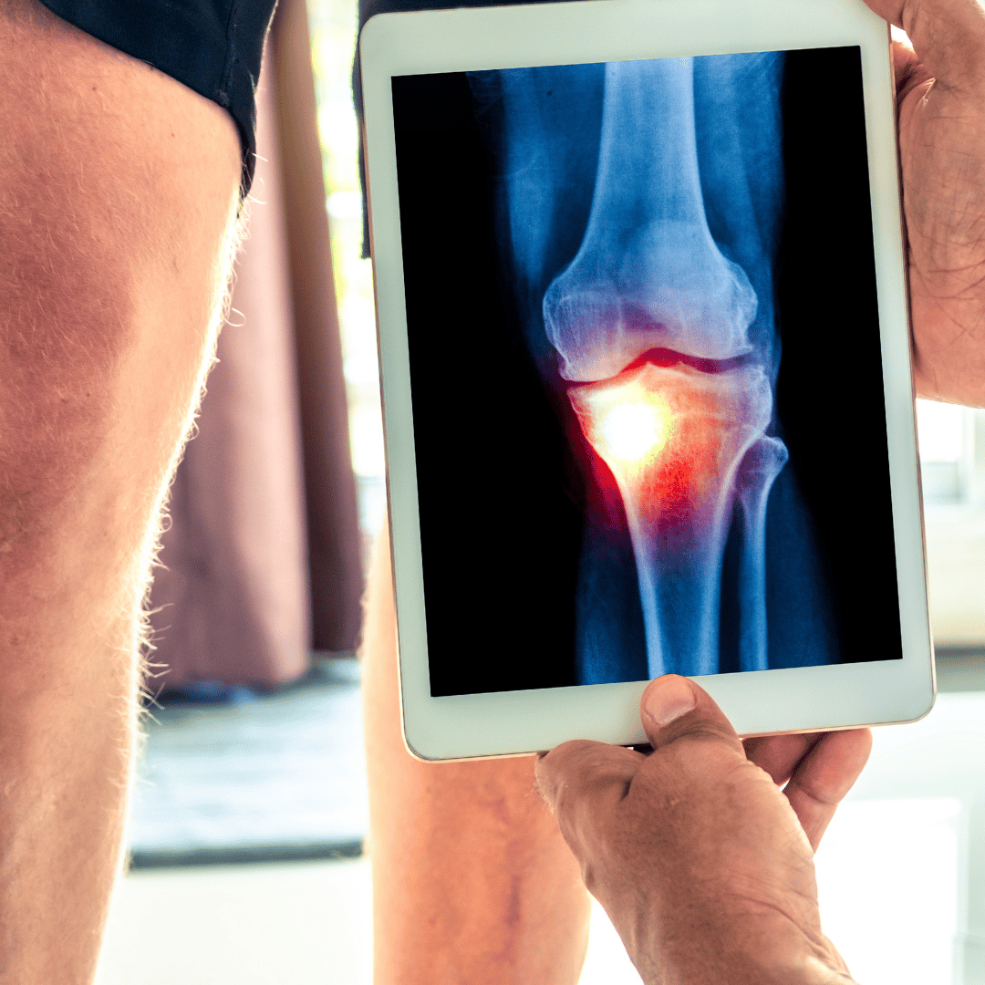 All-Inclusive Stem Cell Therapy Thailand Package: Knee Osteoarthritis Treatment at Vega Clinic