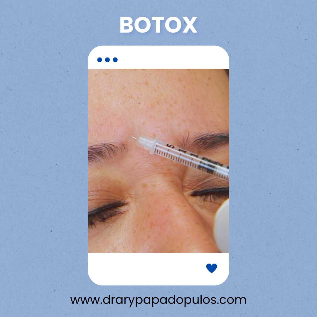 Botox Package at Dr. Ary Papadopulos - Plastic Surgery in Mexico City, Mexico City, Mexico