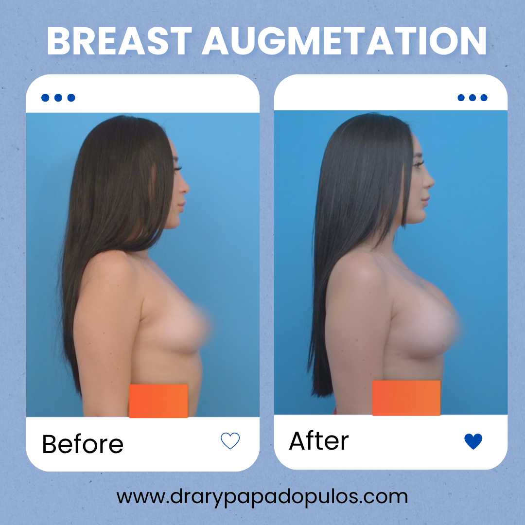 Breast Augmentation Mexico City – Affordable Package with Dr. Ary Papadopulos