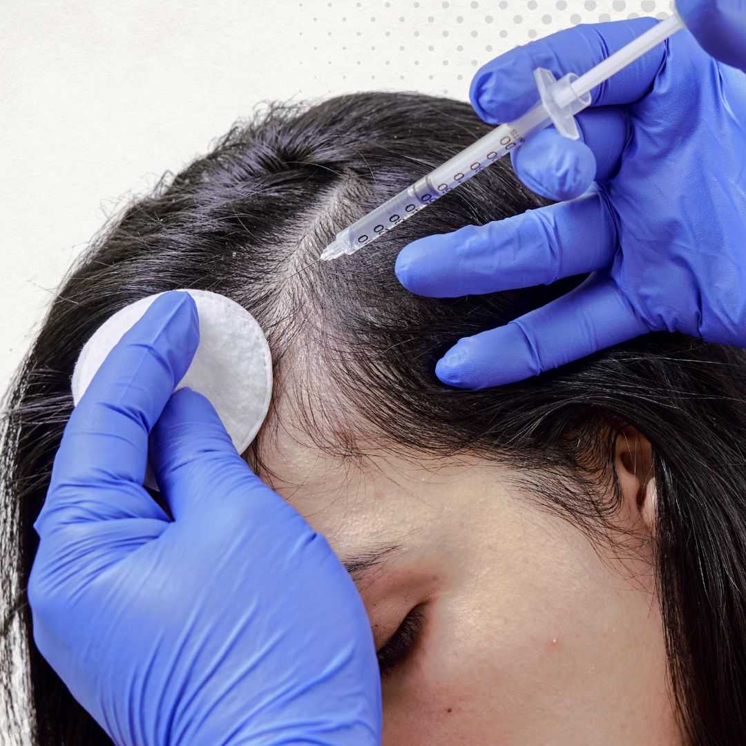 Non-Surgical Stem Cell Hair Restoration Mexico Package at CellsTime Guadalajara