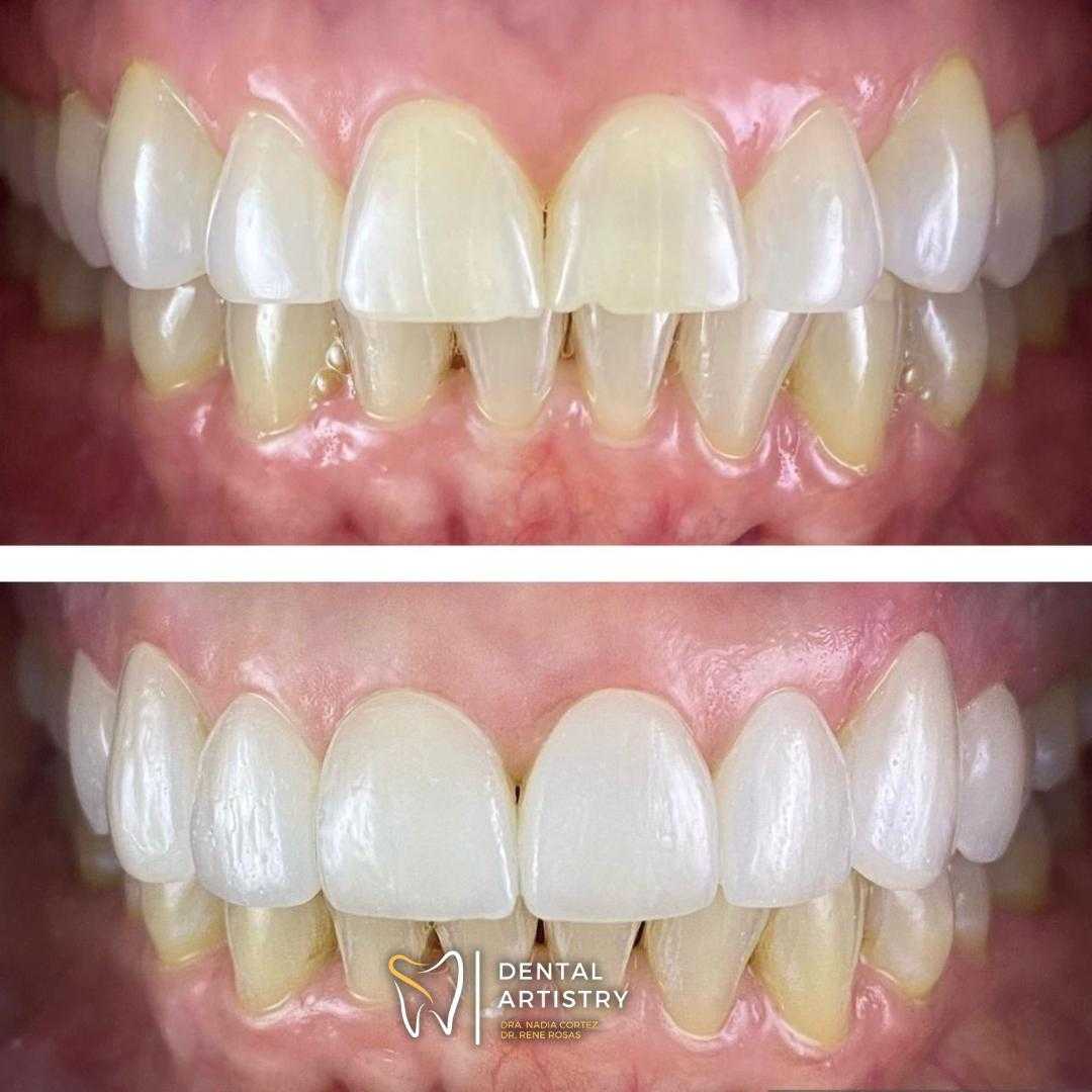 Dental Bonding & Resin Fillings Package in Nuevo Progreso, Mexico